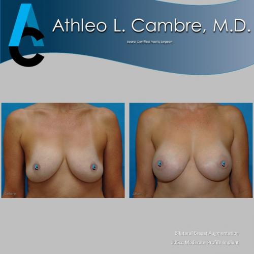 Breast Aug - Before  After (1)