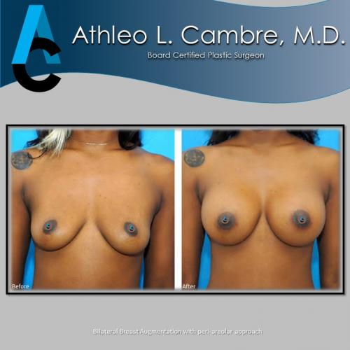 Breast Aug - Before  After 5